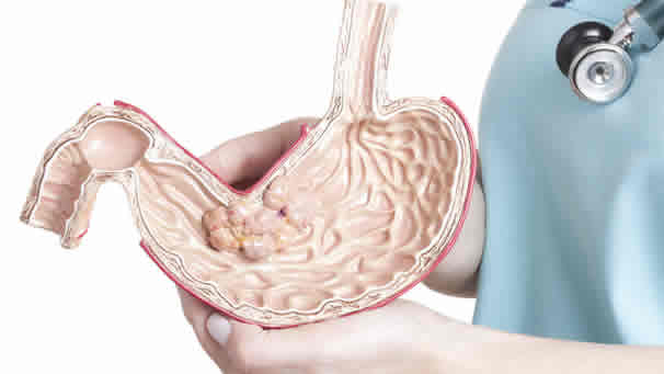 Cáncer gástrico o de estómago