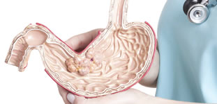 Cáncer gástrico o de estómago